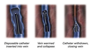 Radiofrequency Ablation