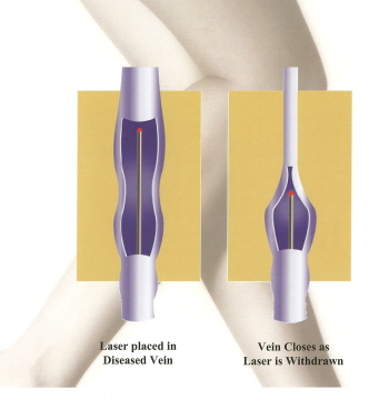 Laser Ablation